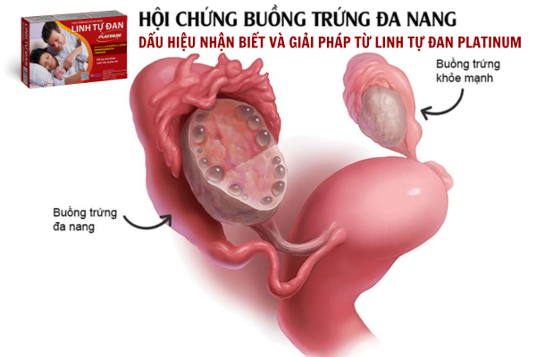 Đa nang buồng trứng: Dấu hiệu và giải pháp từ Linh Tự Đan Platinum