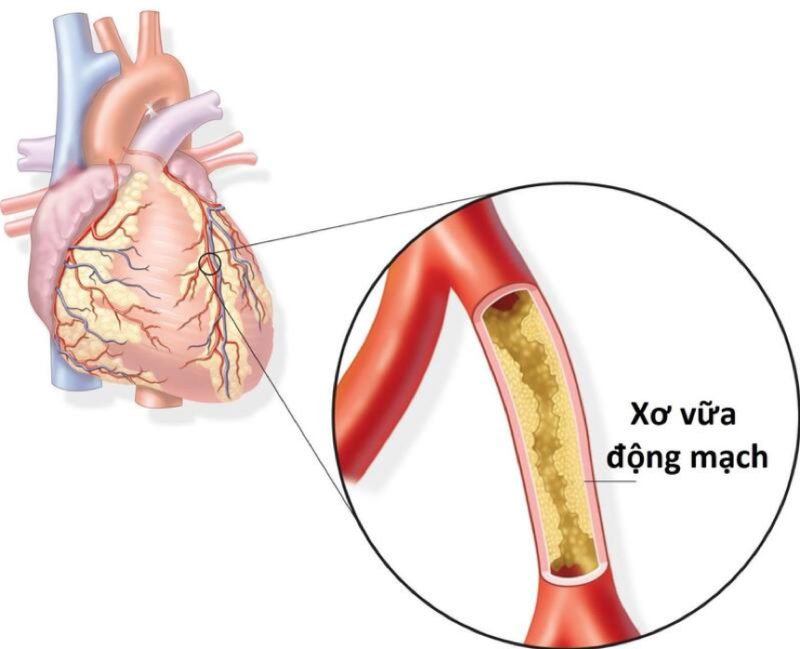Máu nhiễm mỡ làm tăng nguy cơ nhồi máu cơ tim
