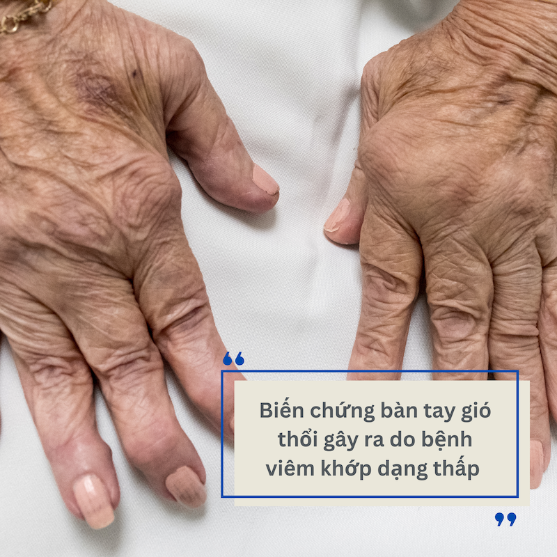 Bàn tay gió thổi: Dấu hiệu và giải pháp phòng ngừa từ Hoàng Thấp Linh