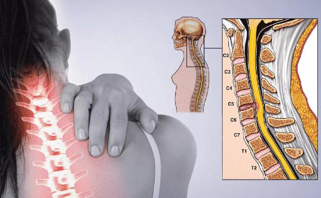 Biến chứng của thoái hóa đốt sống cổ và giải pháp phòng ngừa từ Cốt Thoái Vương