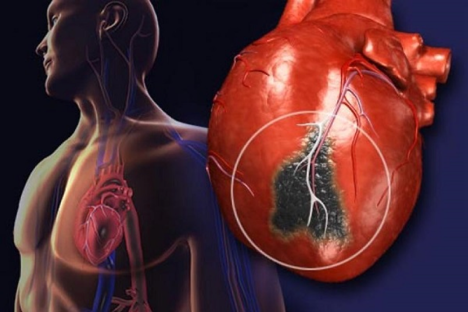 Huyết &aacute;p cao k&eacute;o d&agrave;i l&agrave;m tăng nguy cơ suy tim