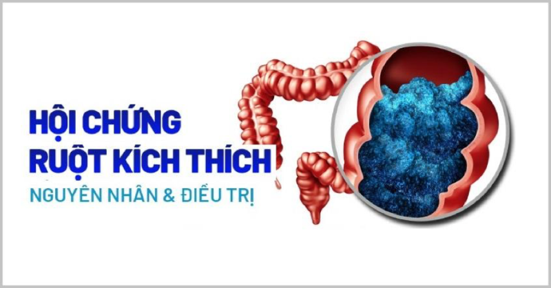 Hội chứng ruột kích thích còn được gọi là bệnh đại tràng co thắt