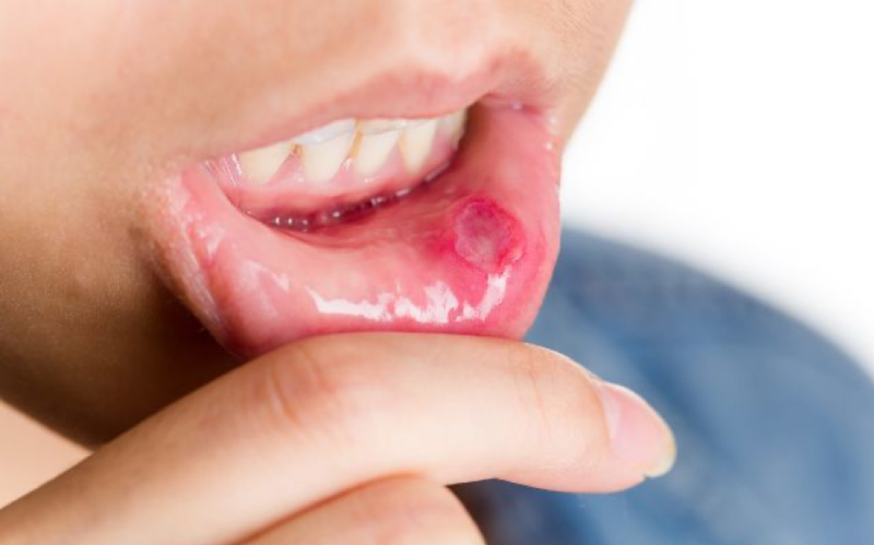 Nhiệt miệng gây đau xót khi ăn uống
