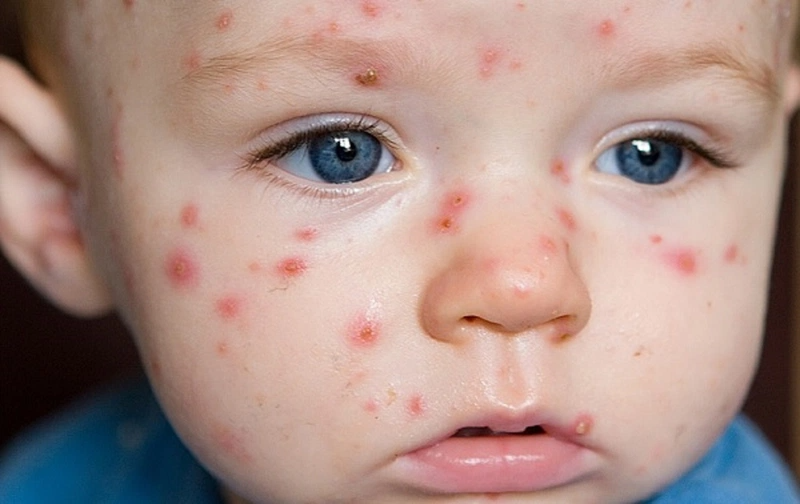 Hà Nội xuất hiện ca mắc Rubella đầu tiên trong năm 2024, phòng tránh bệnh thế nào?