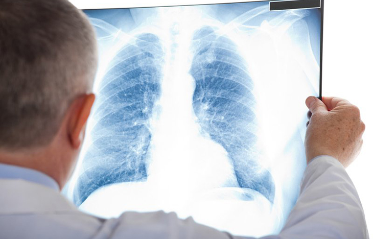 Lao phổi nếu không điều trị sớm sẽ lan ra ngoài phổi, gây tràn dịch màng phổi, xơ phổi, ho ra máu, thậm chí gây tử vong. Ảnh internet.