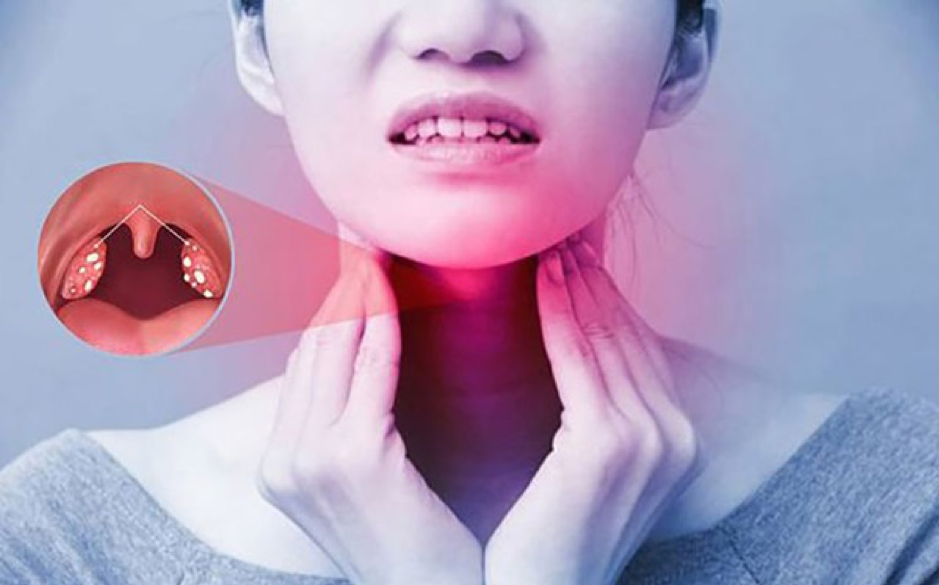 Nhiễm vi khuẩn là nguyên nhân phổ biến gây đau họng