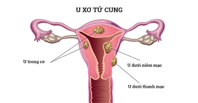 U xơ tử cung là bệnh lý thường gặp ở phụ nữ đang trong độ tuổi sinh sản