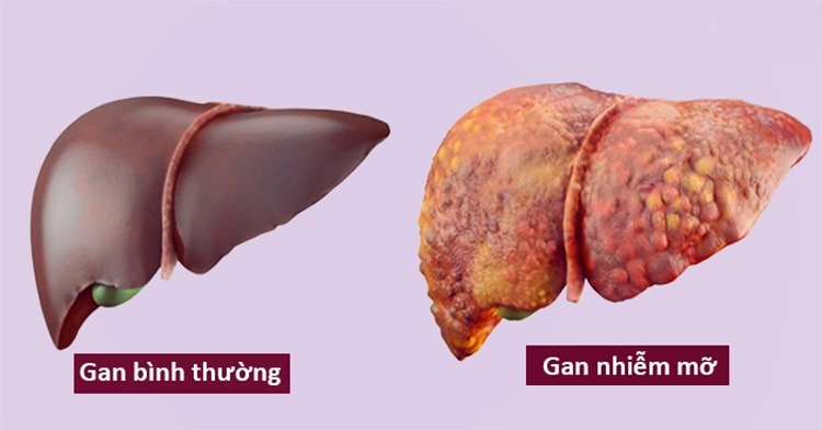 Gan nhiễm mỡ gây men gan tăng cao Gan nhiễm mỡ gây men gan tăng cao