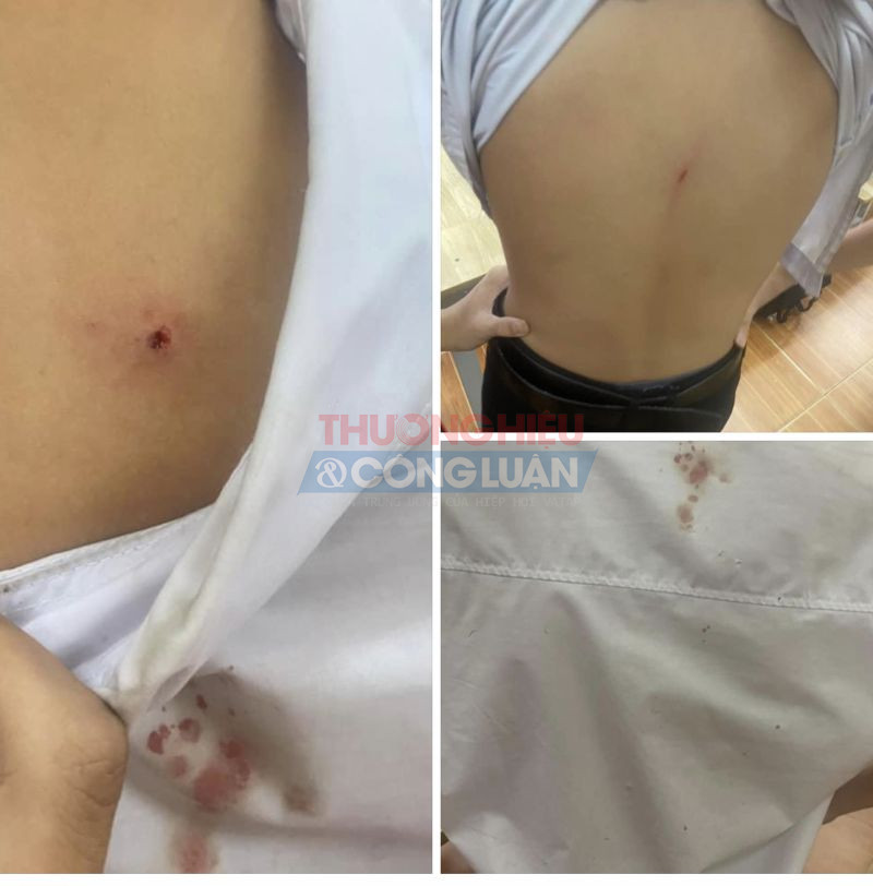 Thông tin về việc bảo vệ dùng cán chổi tác động vật lý gây xước da sau lưng cho học sinh lớp 9