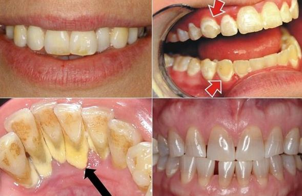 Cao răng được chia thành 4 cấp độ khác nhau