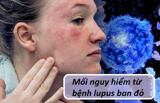 Mối nguy hiểm từ bệnh lupus ban đỏ và giải pháp từ Kim Miễn Khang