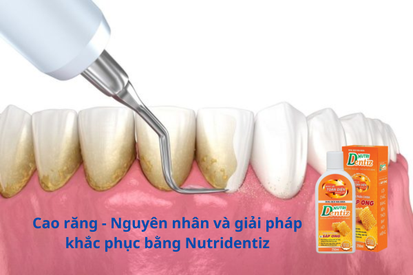 Cao răng - Nguyên nhân và giải pháp khắc phục bằng Nutridentiz