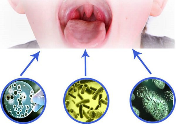 Nhiễm vi khuẩn, virus l&agrave; nguy&ecirc;n nguy&ecirc;n nh&acirc;n phổ biến g&acirc;y vi&ecirc;m họng mạn t&iacute;nh