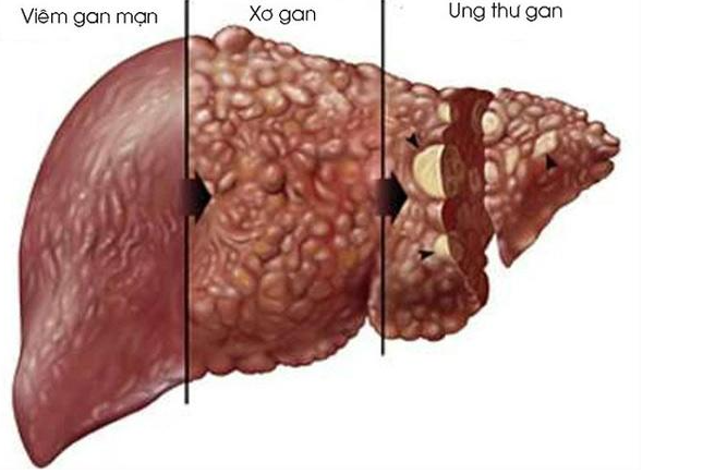 Viêm gan B - Kẻ thù thầm lặng cần luôn đề phòng