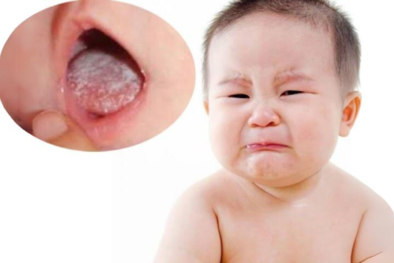 Nấm lưỡi khiến trẻ khó chịu, bỏ ăn, bỏ bú Nấm lưỡi khiến trẻ khó chịu, bỏ ăn, bỏ bú