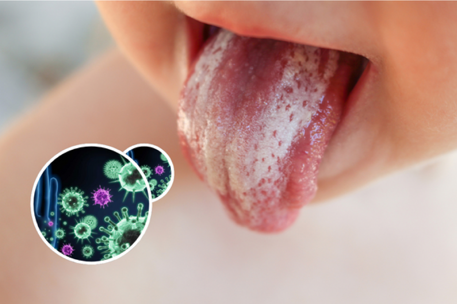 Nấm Candida - Thủ phạm chính gây nấm lưỡi ở trẻ Nấm Candida - Thủ phạm chính gây nấm lưỡi ở trẻ
