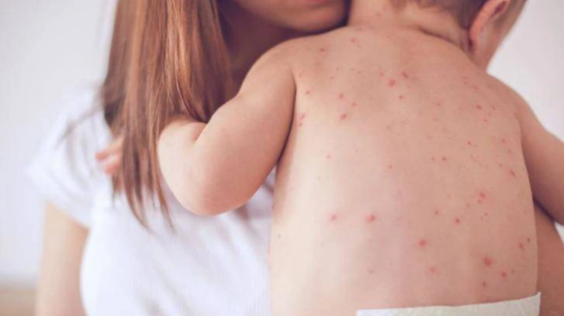 TP. Hồ Chí Minh phát hiện 60 ca sốt phát ban trong tuần, nghi bệnh sởi