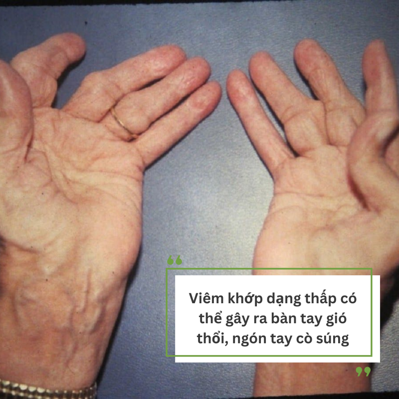 Biến dạng khớp do viêm khớp dạng thấp và giải pháp ngăn ngừa từ Hoàng Thấp Linh