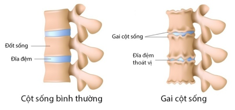 Gai cột sống thắt lưng được mô tả là sự phát triển thêm ra của xương đốt sống