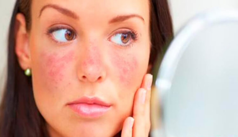 Triệu chứng hồng ban c&aacute;nh bướm tr&ecirc;n mặt của người bị lupus