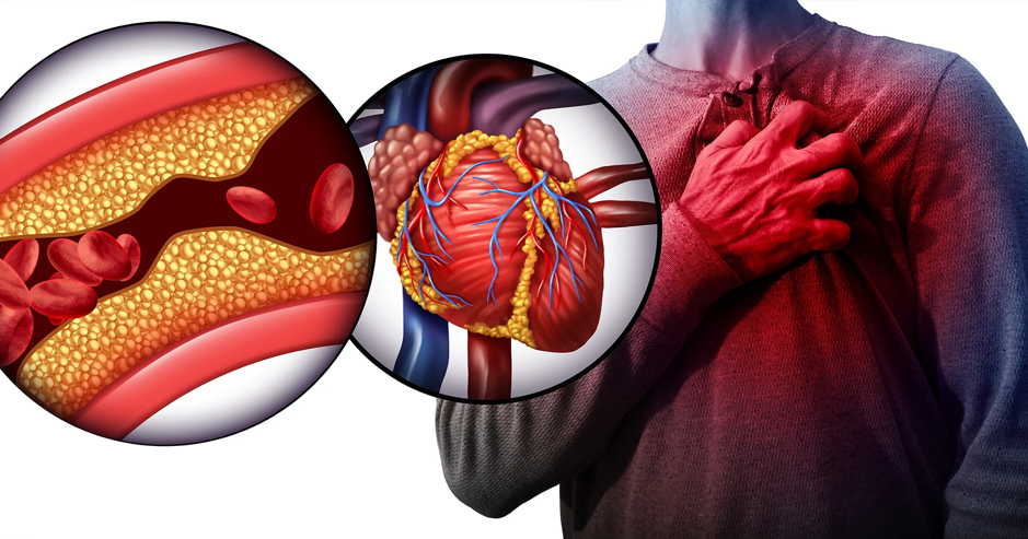 Rối loạn lipid máu có thể gây nhiều biến chứng nguy hiểm Rối loạn lipid máu có thể gây nhiều biến chứng nguy hiểm