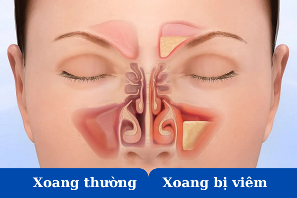 Phòng và điều trị viêm xoang với xịt mũi họng Khiết Thanh