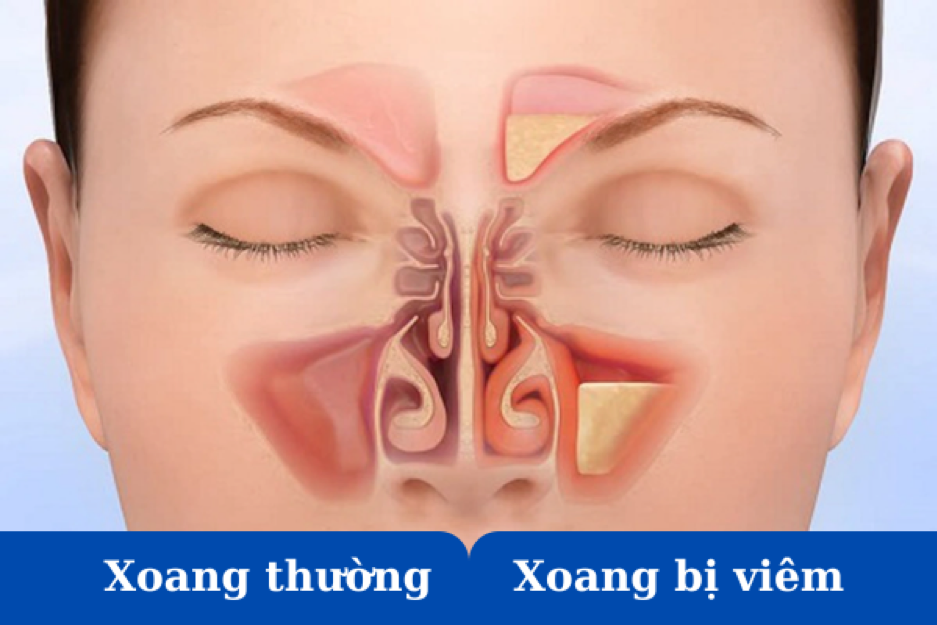 Cấu tạo xoang ở người bình thường và người bị viêm xoang