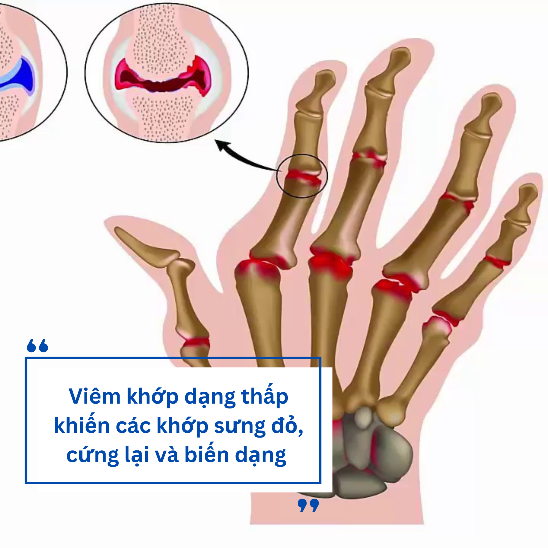 Viêm khớp dạng thấp: Nguyên nhân và giải pháp cải thiện từ Hoàng Thấp Linh