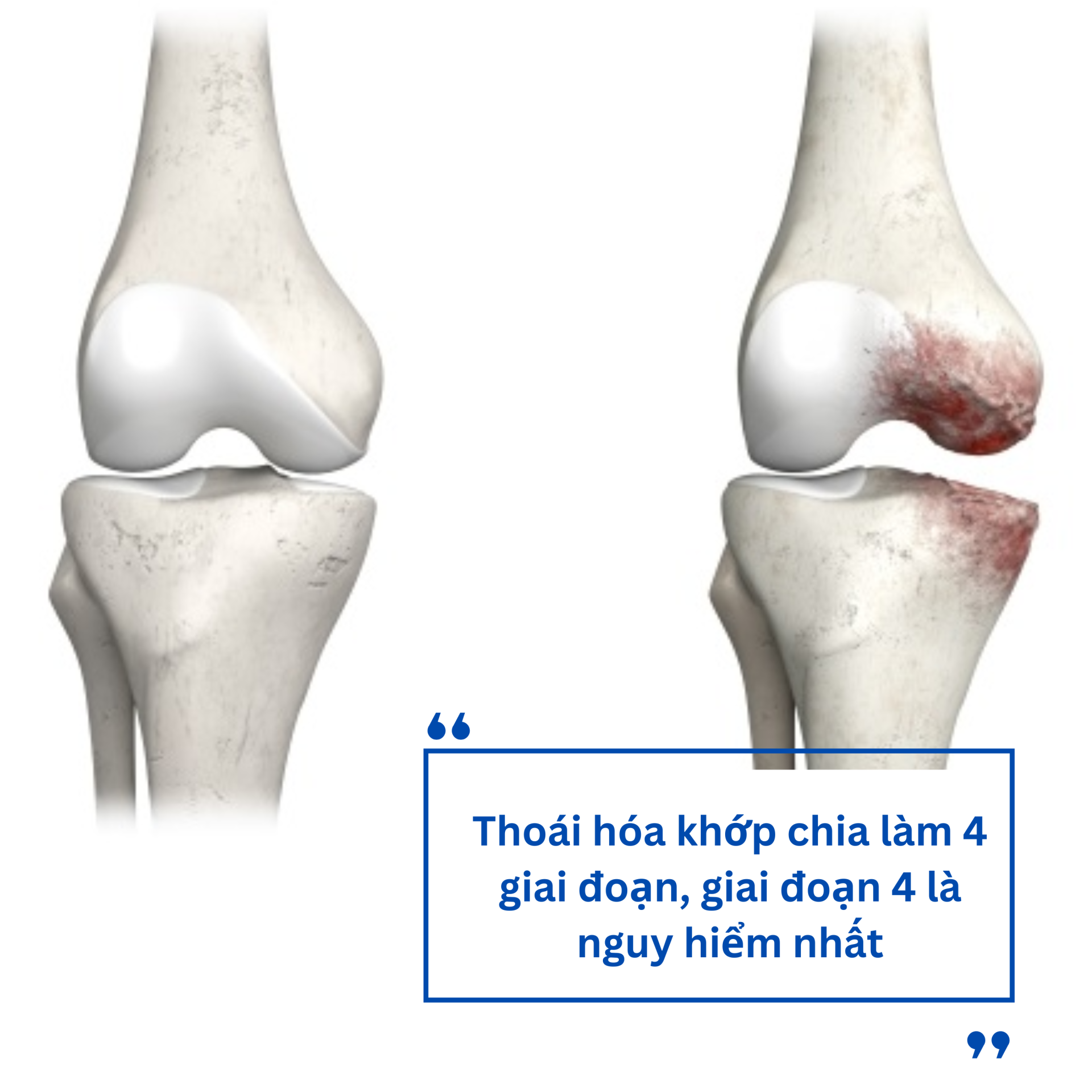4 Giai đoạn của thoái hóa khớp và giải pháp từ CốtWells chứa màng vỏ trứng