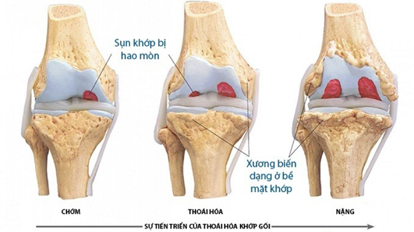 Thoái hóa khớp là tình trạng bào mòn sụn và xương dưới sụn gây sưng đau khớp