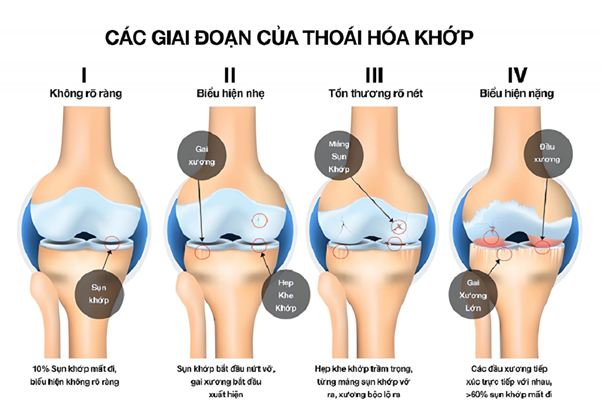 Giai đoạn 4 là giai đoạn nghiêm trọng nhất của thoái hóa khớp, các đầu sụn bị bào mòn gần như toàn bộ, người bệnh có nguy cơ phải thay khớp