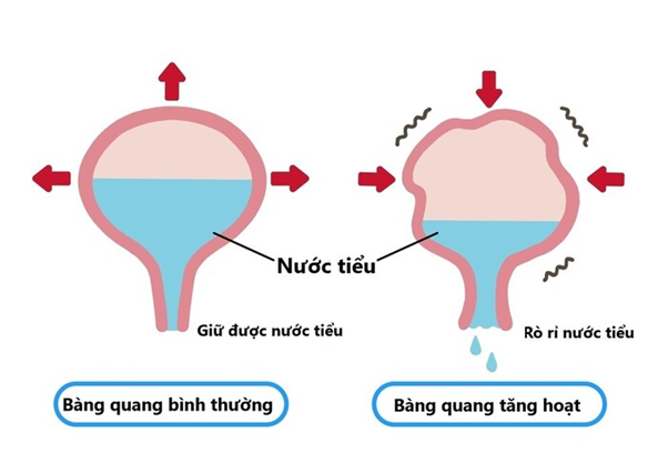 Bàng quang tăng hoạt là tình trạng phổ biến