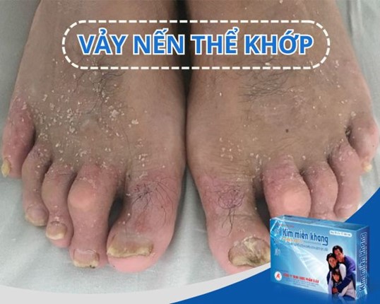 Vảy nến thể khớp g&acirc;y biến dạng khớp