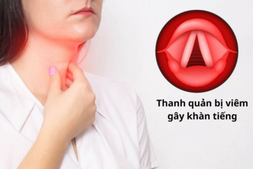 Khàn tiếng là triệu chứng đặc trưng của viêm thanh quản