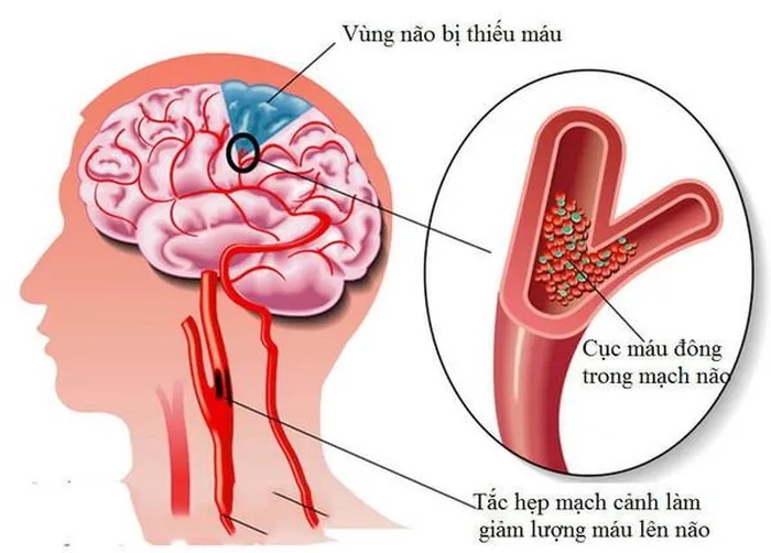 Thiếu máu lên não là tình trạng máu nuôi lên não không đủ, khiến tế bào não không được cung cấp đủ oxy và dưỡng chất cần thiết. Ảnh minh họa