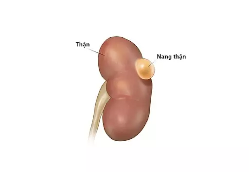 Hình ảnh nang thận trái