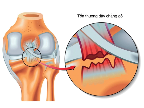 Dây chằng chéo là bộ phận quan trọng của khớp gối