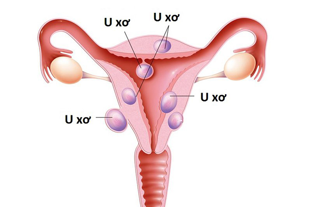 Đa nhân xơ tử cung là tình trạng không hiếm gặp