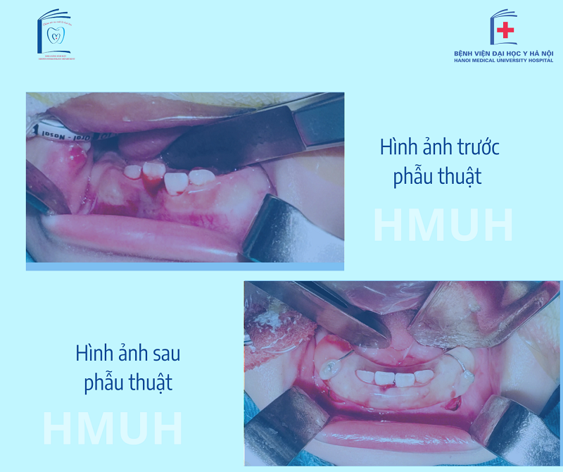 Hình ảnh trước và sau phẫu thuật của bệnh nhi