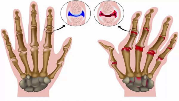 Giải pháp giảm đau khớp từ thảo dược - Bách Thống Vương
