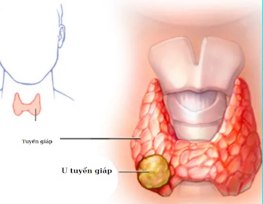 Nhân tuyến giáp tirads 3 và cách điều trị bệnh hiệu quả, tránh phải mổ