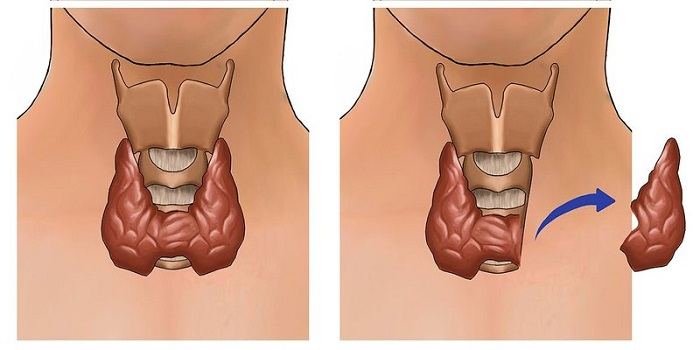 Phẫu thuật được chỉ định cho các trường hợp có nhân giáp quá to hoặc ác tính