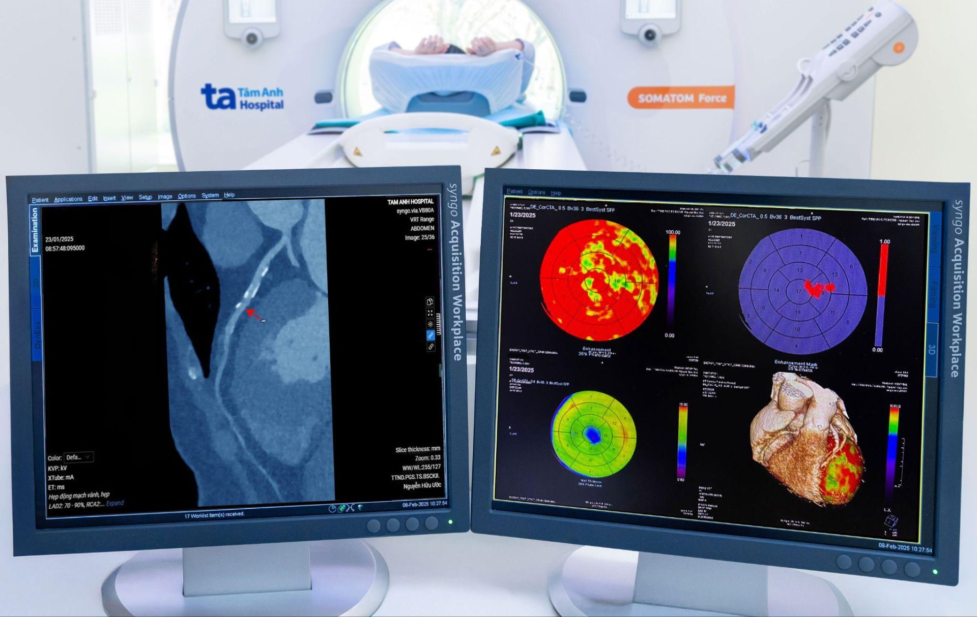 Hình ảnh chụp CT mạch vành (bên trái) và bản đồ tưới máu cơ tim (bên phải) của người bệnh trên phim chụp CT Somatom Force VB30, hỗ trợ đắc lực cho bác sĩ khi chẩn đoán bệnh. Hình ảnh chụp CT mạch vành (bên trái) và bản đồ tưới máu cơ tim (bên phải) của người bệnh trên phim chụp CT Somatom Force VB30, hỗ trợ đắc lực cho bác sĩ khi chẩn đoán bệnh.