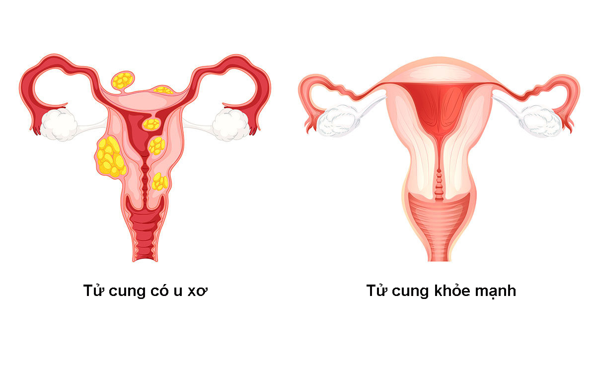 U xơ tử cung thường gặp ở phụ nữ từ 30 tuổi trở lên U xơ tử cung thường gặp ở phụ nữ từ 30 tuổi trở lên