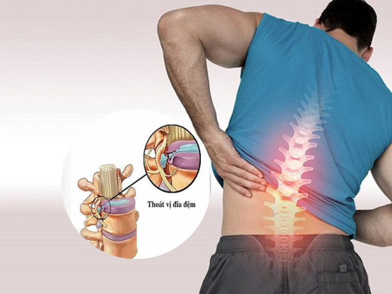 4 giai đoạn thoát vị đĩa đệm và giải pháp cải thiện hiệu quả từ Cốt Thoái Vương