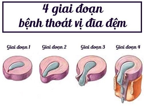 Hình ảnh 4 giai đoạn tiến triển của bệnh thoát vị đĩa đệm