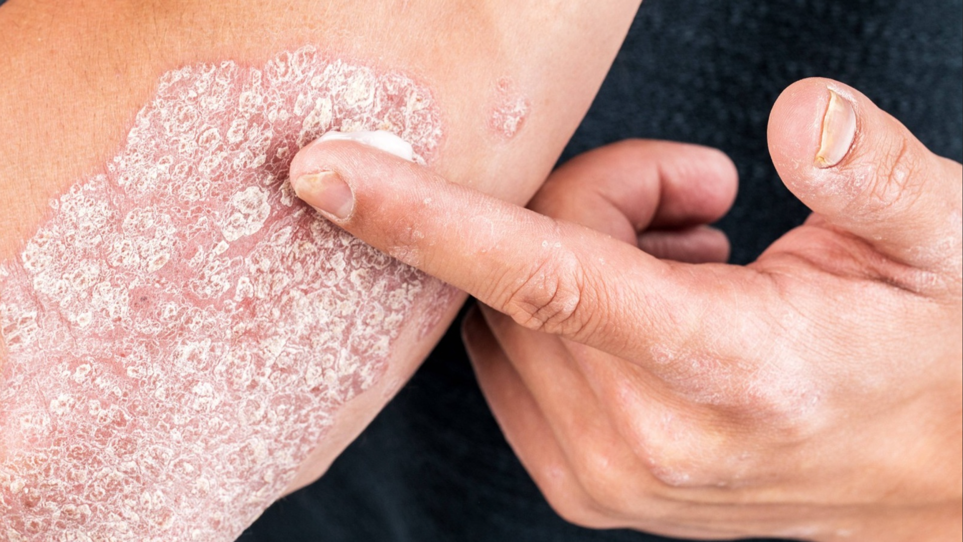 Dùng kem bôi vảy nến mãi vẫn tái phát - thử ngay viên uống thảo dược Kim Miễn Khang