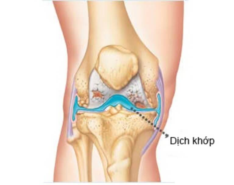 Khô khớp gối là tình trạng khớp sản xuất quá ít dịch nhầy bôi trơn