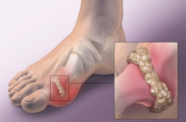 Axit uric tăng cao kết tinh thành muối urat gây bệnh gout Axit uric tăng cao kết tinh thành muối urat gây bệnh gout