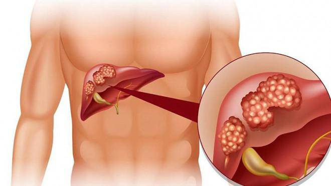 Gan bị tổn thương có thể dẫn đến ung thư gan Gan bị tổn thương có thể dẫn đến ung thư gan
